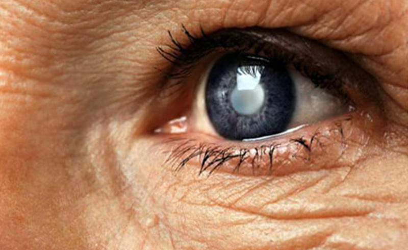 Do cataract surgeries in Dubai hurt?