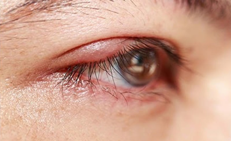 All you need to know about blepharitis