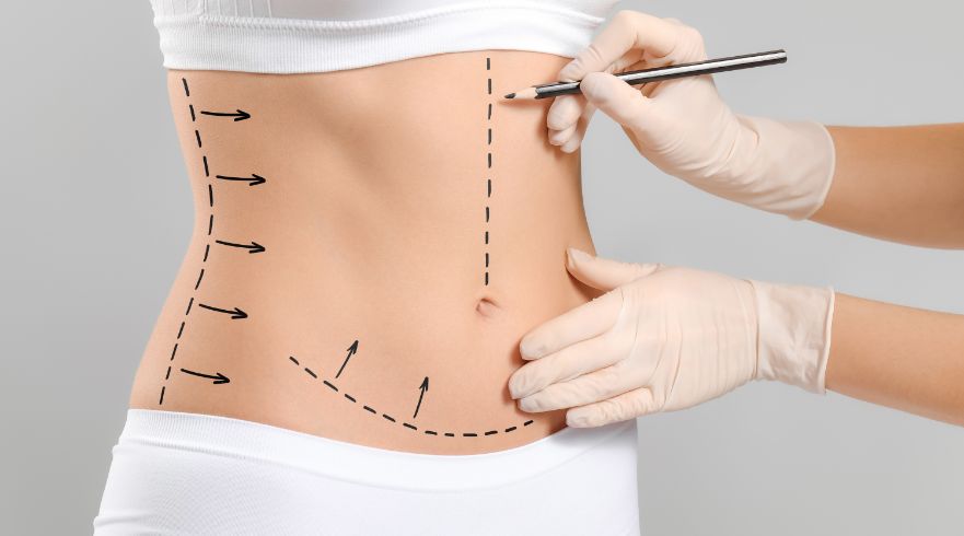 Liposuction and liposculpting